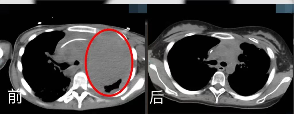 胸腔CT前后對比。四川省腫瘤醫院供圖