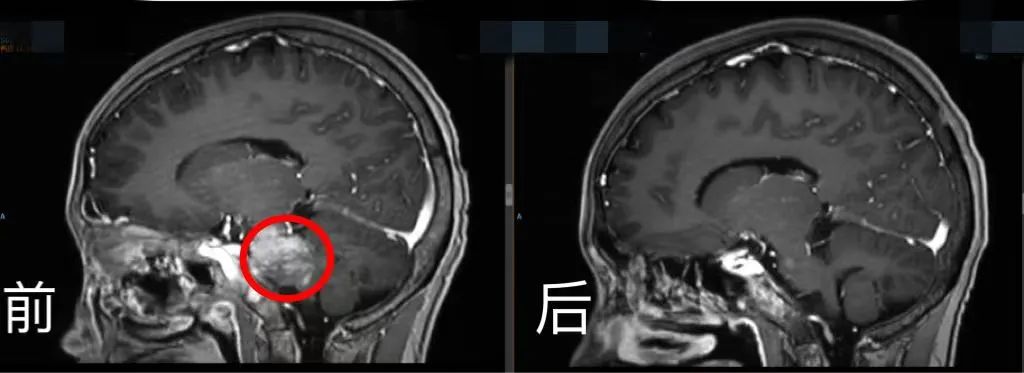 腦部CT前后對比。四川省腫瘤醫院供圖